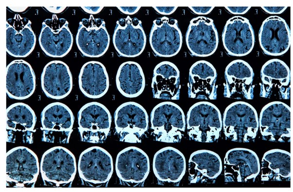 DNA methylation in Alzheimer’s Disease