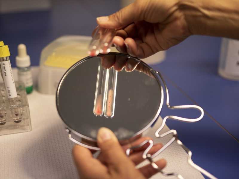 肝癌切除手術預後評估 肝癌切除手術預後評估